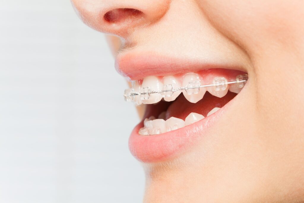 braces in Dallas tx