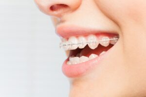 Clear Braces vs Metal Braces in Dallas: What Patients Need To Know