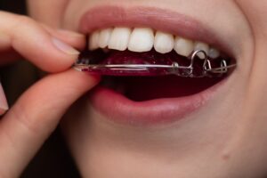 What Happens After Braces or Invisalign? A Dallas Guide to Retainers and Keeping Teeth Straight